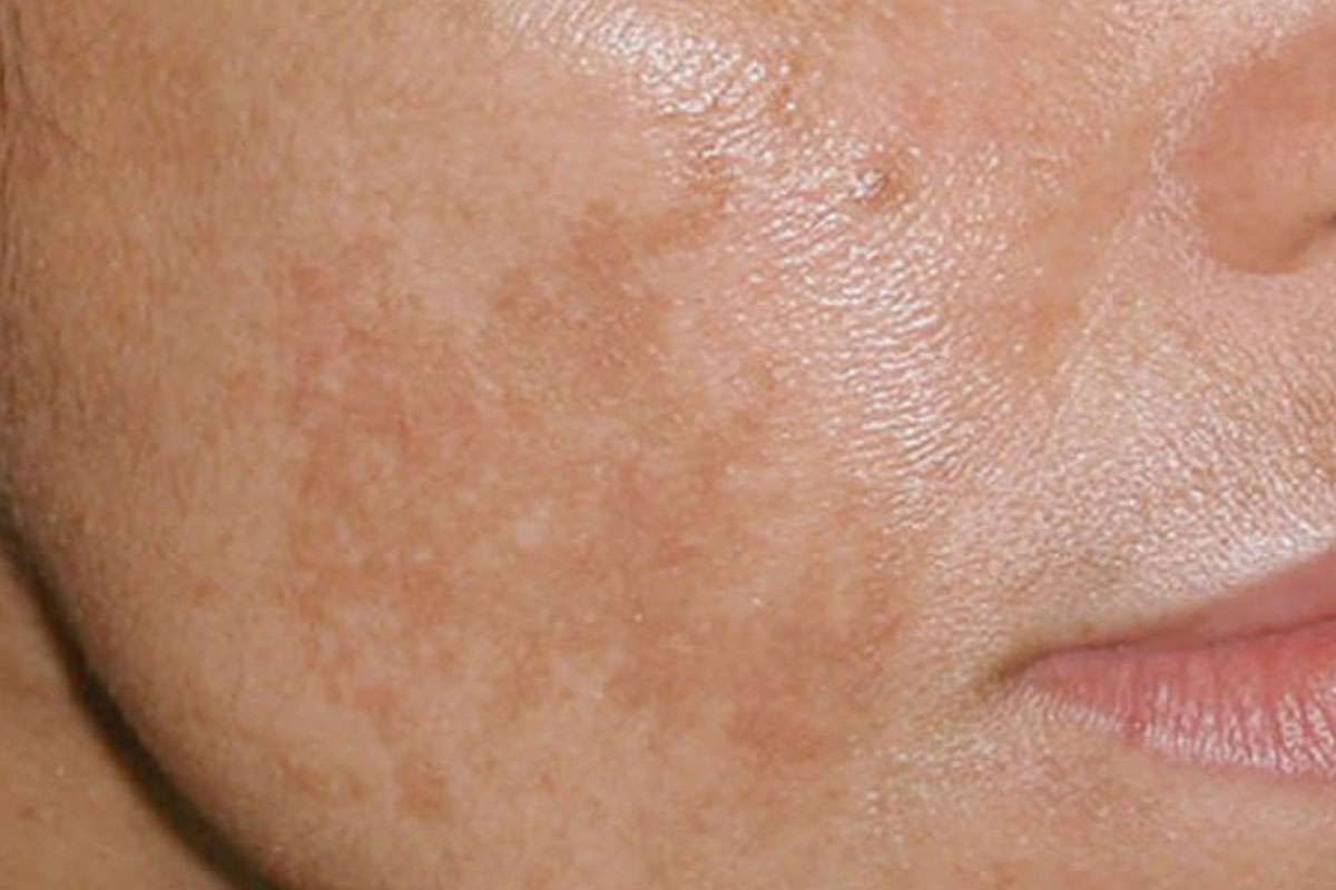 https://cdn.prod.website-files.com/6077bba36e3ae9ede40e387d/60c04a7520924f1d7abf456e_brown-spots-and-melasma.jpg